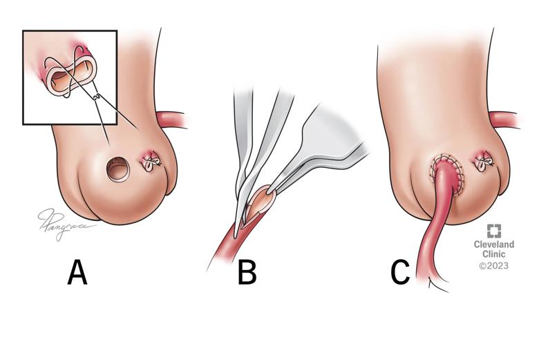 illustrations of three steps in an operation on the aorta