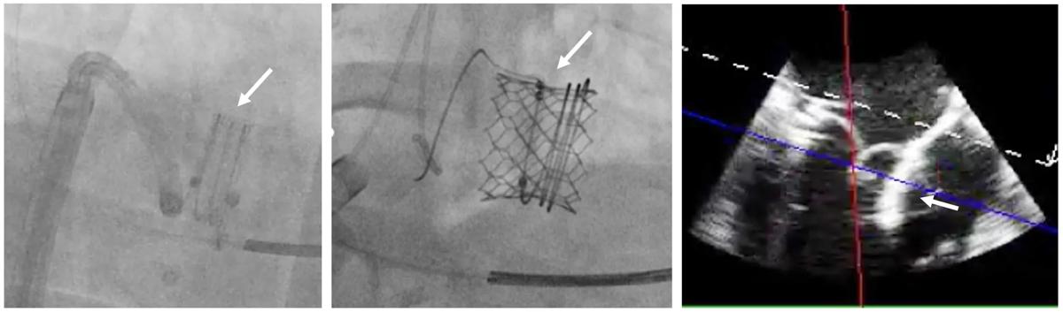 two scans of a stented heart valve next to an echocardiogram image