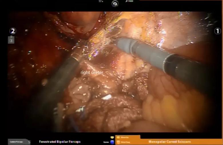 Iliac vein