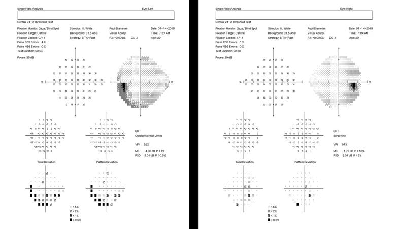 The right eye visual field is largely normal. The left field demonstrates an inferotemporal arcuate defect due to his retinal detachment.