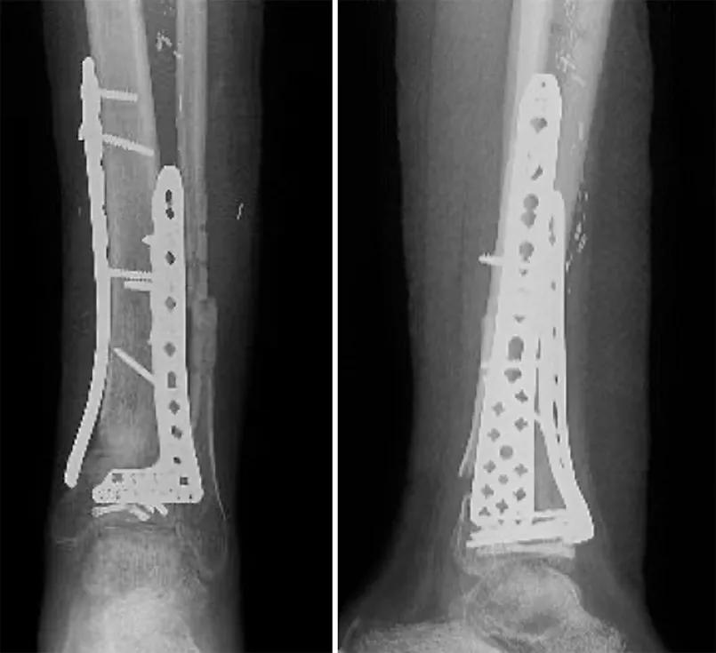 X-rays three months after surgery
