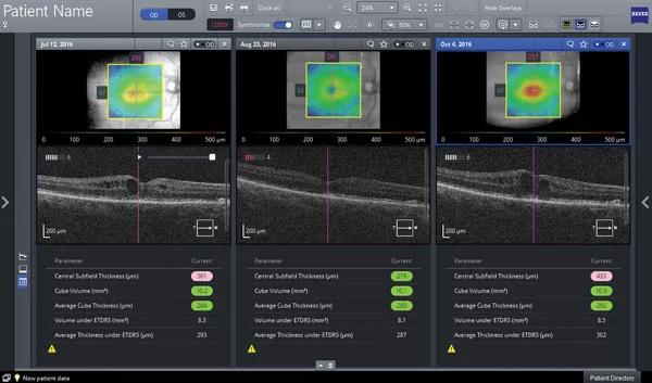 Figure. Our physicians use an advanced ophthalmic imaging platform which collates information on patient anatomic changes from multiple visits on one easy-to-read screen. This allows quick observation of longitudinal changes and faster decision-making regarding treatment.  