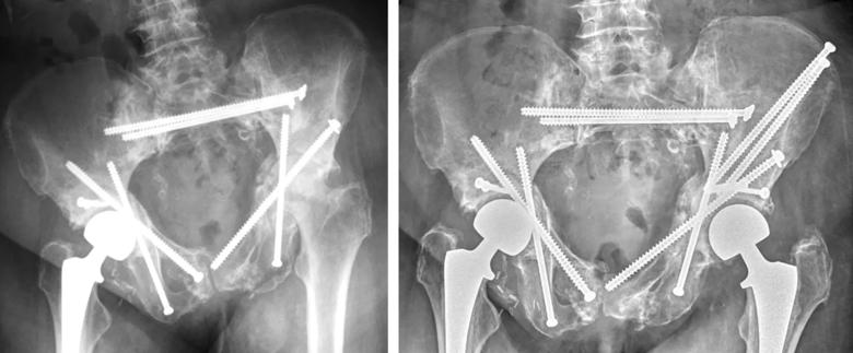 X-ray images of total hip arthroplasty with screw fixation
