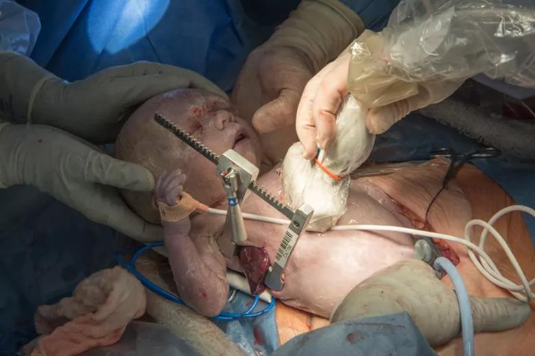 Photo of fetal surgery.