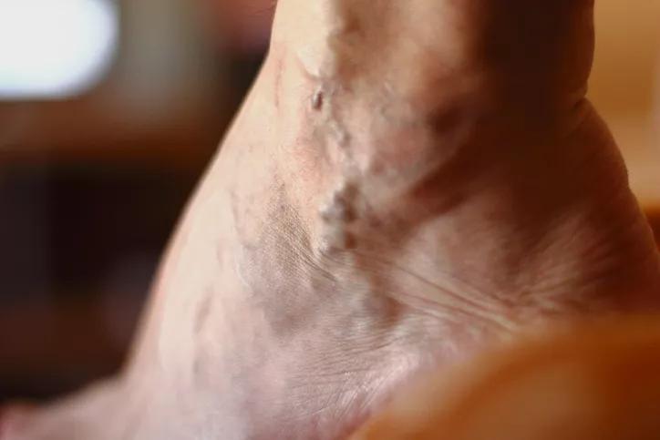 Are Varicose Veins Dangerous? What Are The Symptoms & Treatments? - Laser  Vascular Center