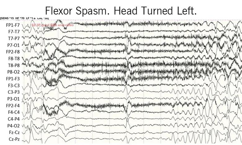 EEG recording