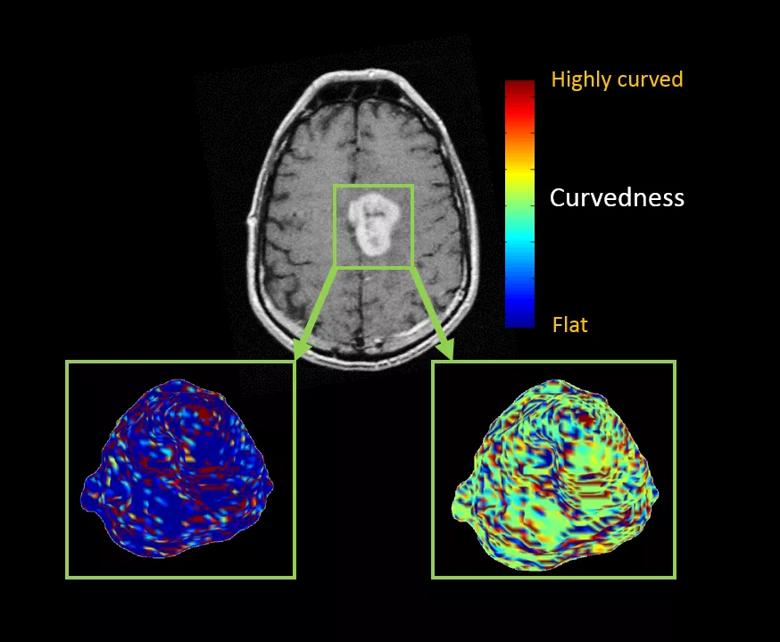 color maps showing a left medial frontal enhancing brain lesion