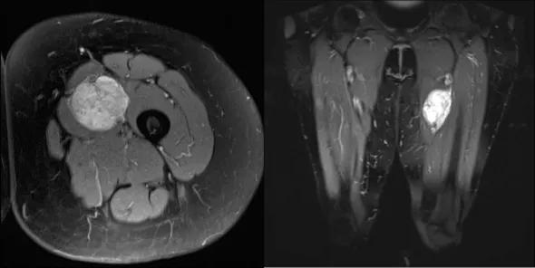 Figure. Axial (left) and coronal (right) MRIs showing the leiomyosarcoma in the left thigh arising from the femoral vein.