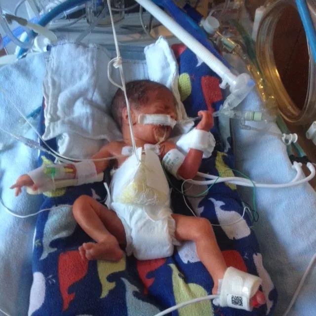 NICU baby born with rare birth defect