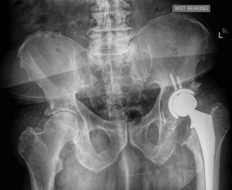 Postoperative X-ray