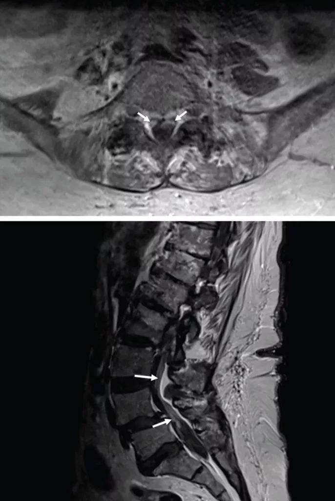  MRIs showed cauda equina enhancement at level L5 to S1 in axial T1  (top) & sagittal T1  (bottom).