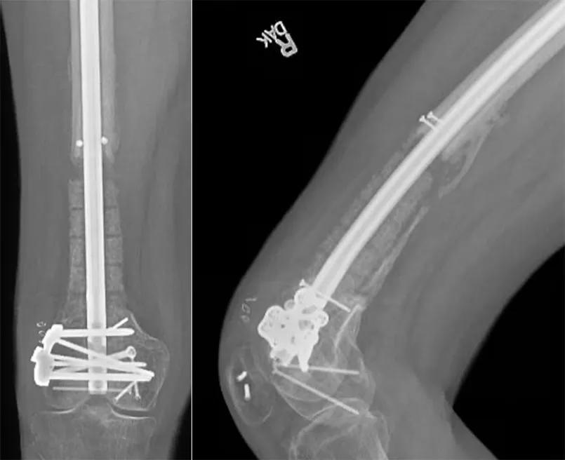 X-rays after surgery