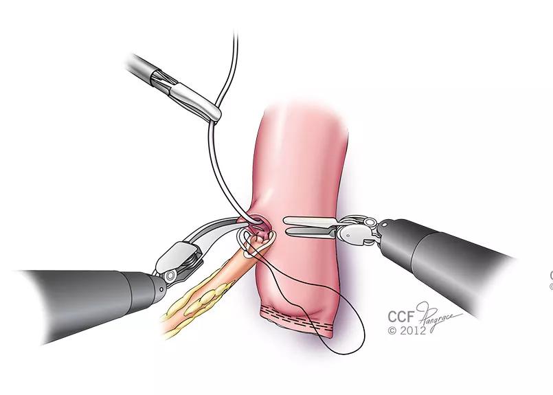 Inset-2-IlEAL-CONDUIT-end-suture_17-76737