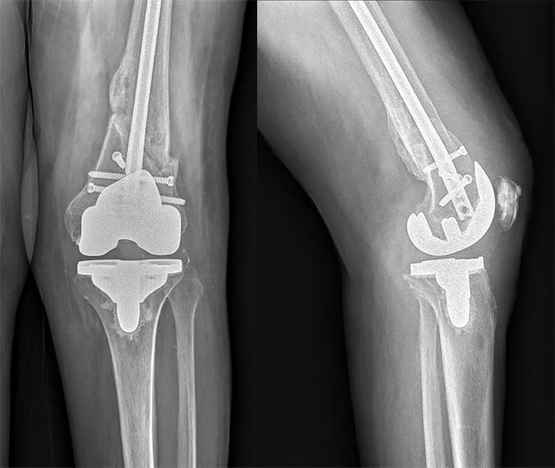 X-ray of knee after surgery