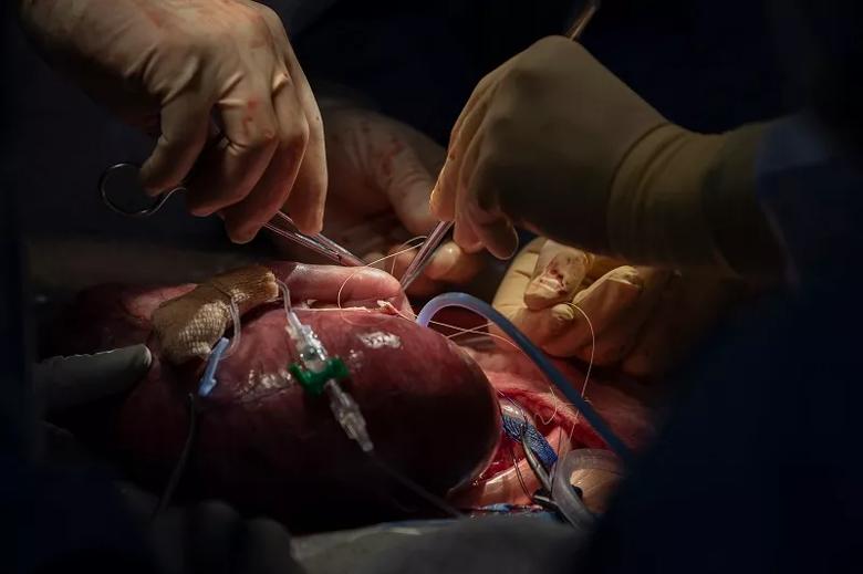 After the lung mass is removed, Dr. Cass sutures to close the fetus’s chest.