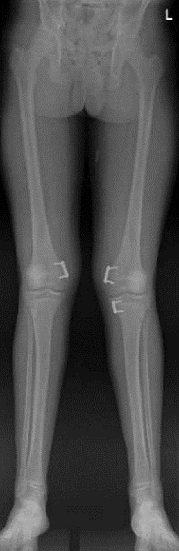 X-ray of patient with tension-band plating