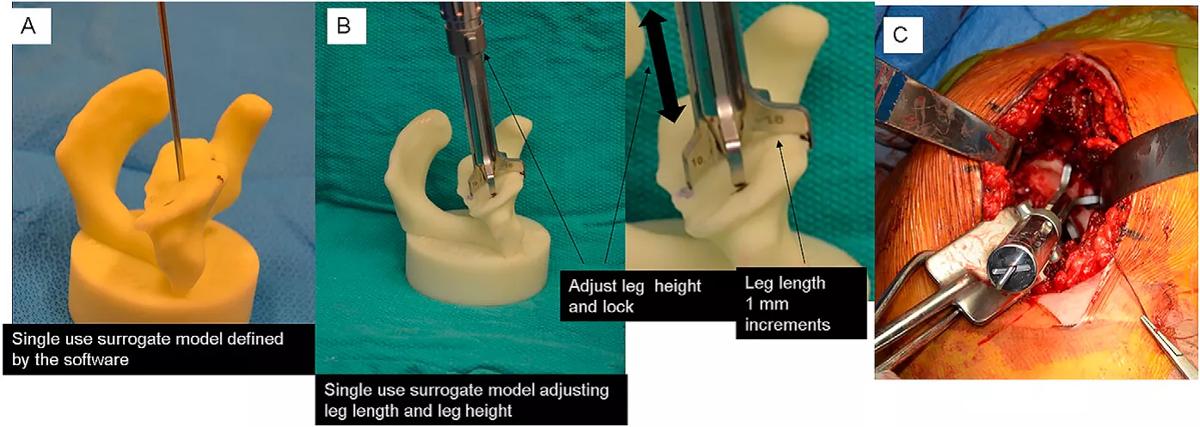 Shoulder surgery