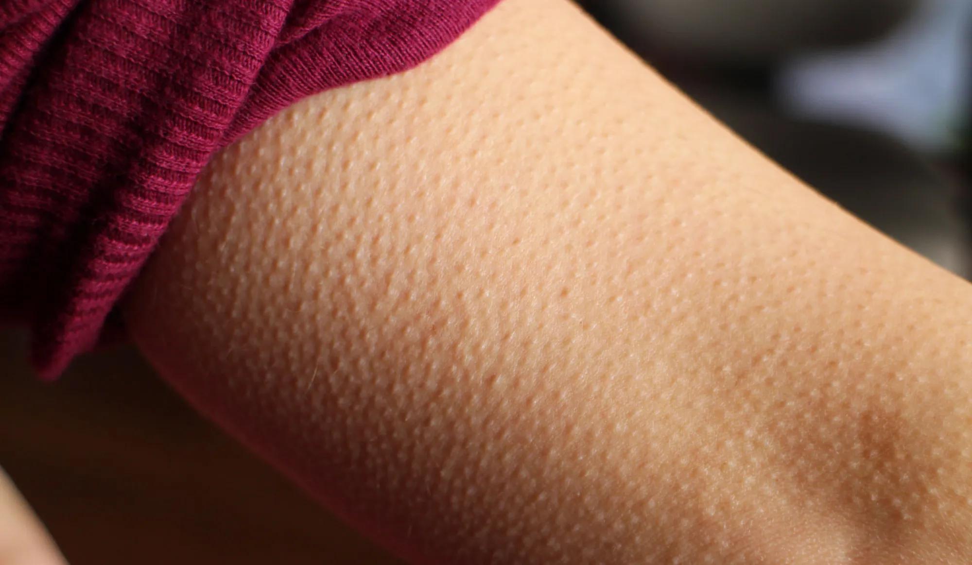 Why You Have Goosebumps on Your Skin