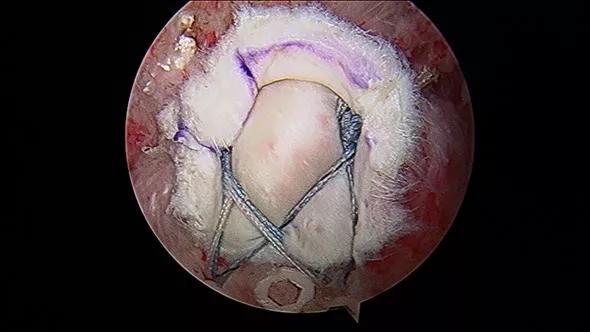 Rotator-Cuff_Gilot_590pxl-width