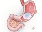 Intragastric balloon
