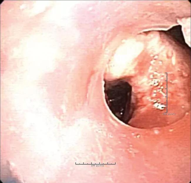 Right main bronchus with granulation.