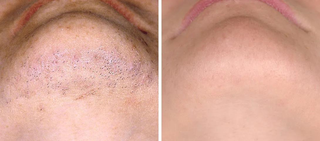 Laser hair removal before and after