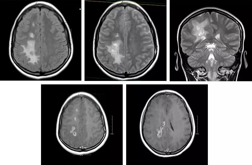 Brain MRI images