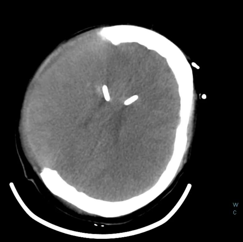 severe swelling of brain as shown on CT scan