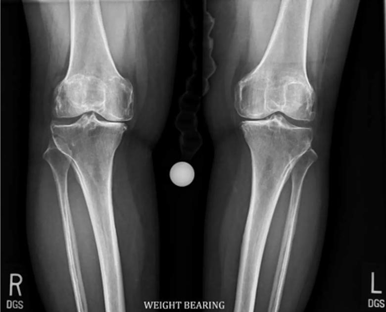 X-ray of patient's knees after losing weight