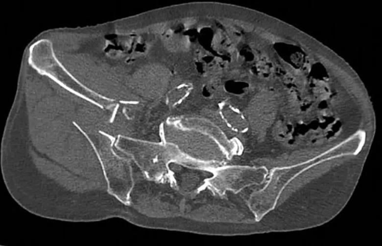 Axial CT image of iliac wing fracture