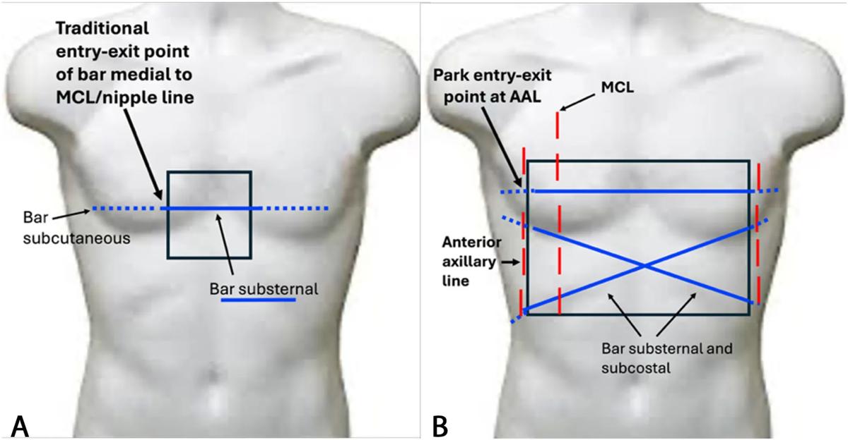 Illustration showing two types of chest wall remodeling