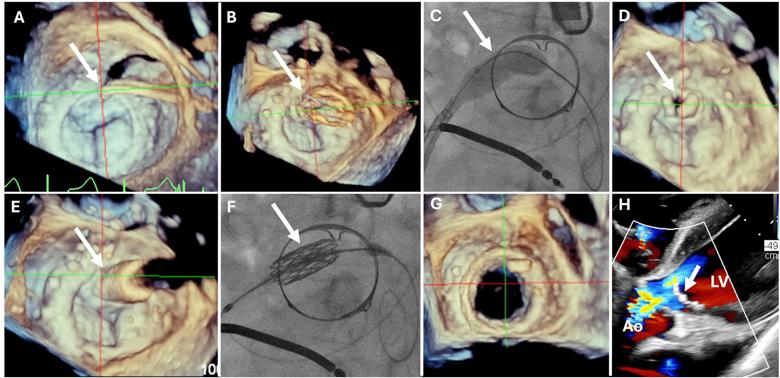 series of eight scanned images of a heart valve