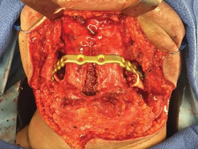 The patient subsequently underwent resection of the central giant cell granuloma