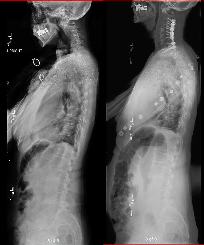 Cervical Kyphosis In A Geriatric Patient A Case Study   22 NEU 3097423 CQD Inset1 800x961 1 Jpg