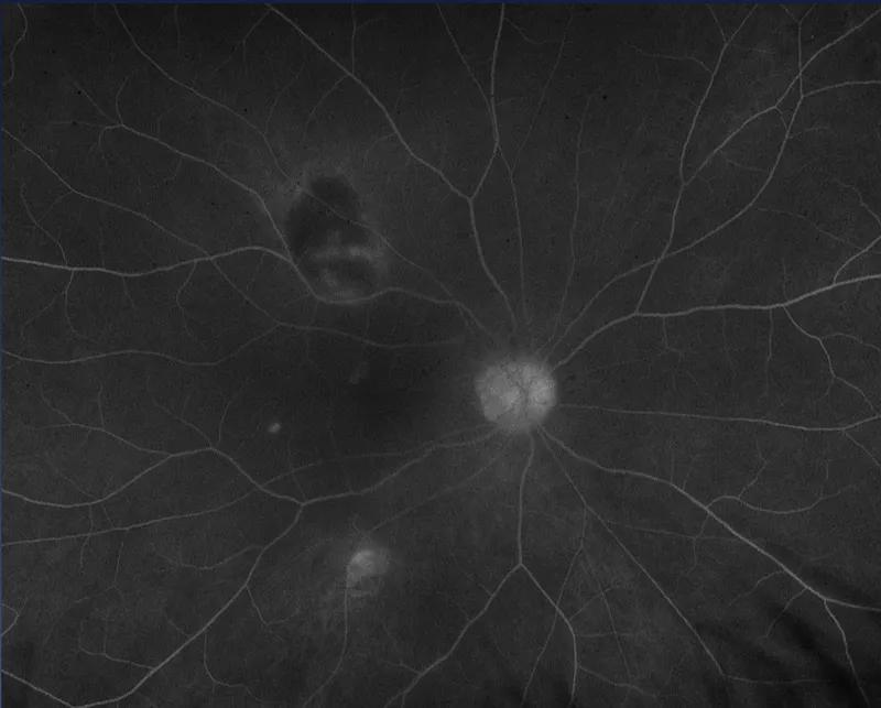 Eye