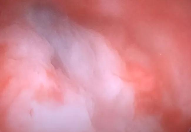 On hysteroscopy, a bluish mass measuring approximately 2 cm was revealed.