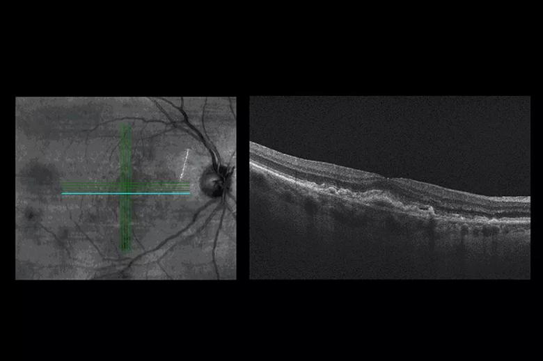OCT of a 74-year-old with dry AMD