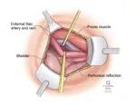 (E) Mobilization of iliac vasculature