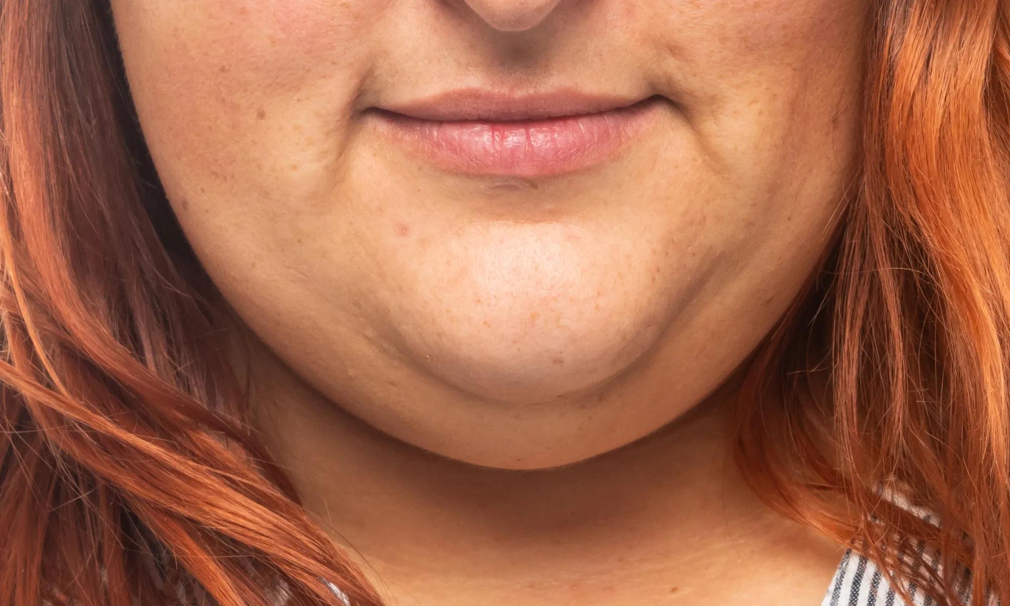 How To Get Rid of a Double Chin