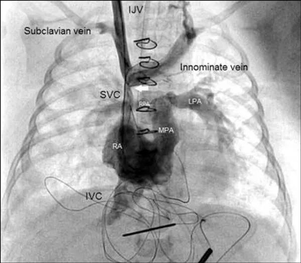 Figure 4. Venogram with injection of contrast bilaterally depicting the normal venous anatomy (not from the case patient).