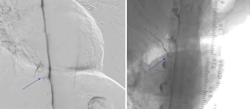 side-by-side medical scans with a blue arrow in each scan