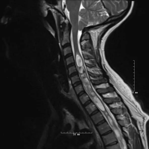 Chiari-fig1