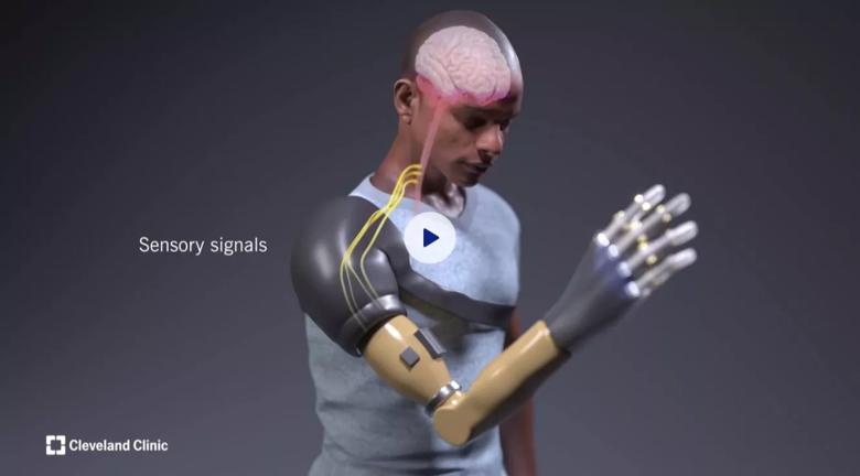 Man With Amputated Arm Gets Bionic Hand in Surgical Breakthrough