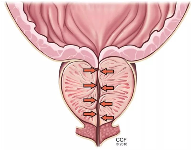 Benign prostatic hyperplasia (BPH)