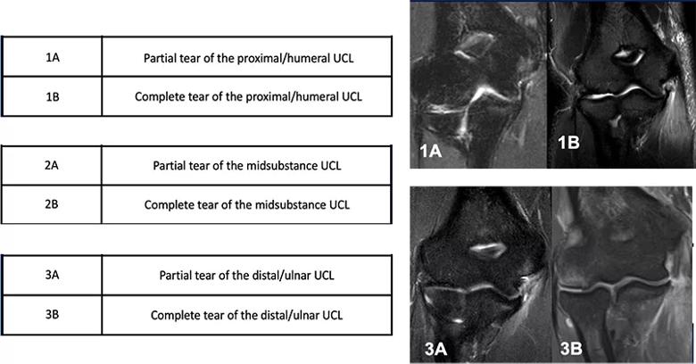 UCL injury classification