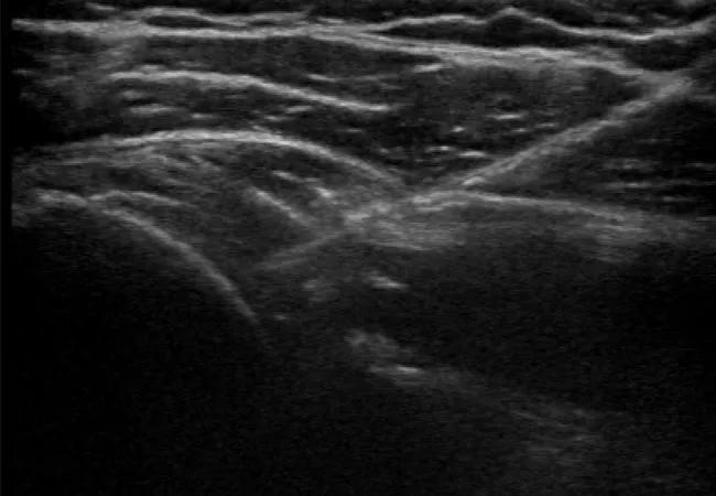 Frozen shoulder