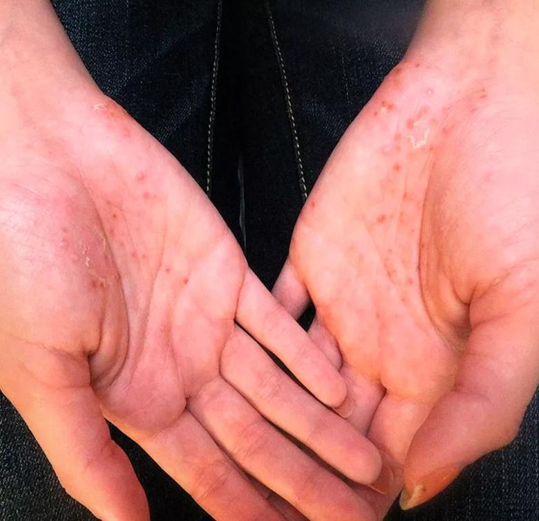 Palmar psoriasis eruption in a patient receiving infliximab treatment for Crohn disease.