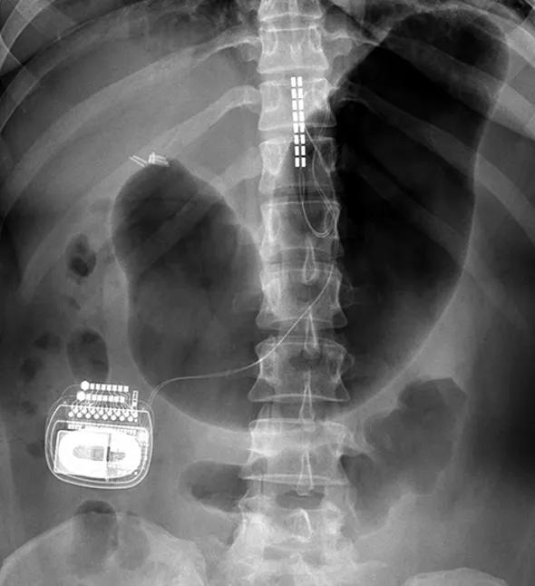 15-NEU-568-SpinalStim-Inset