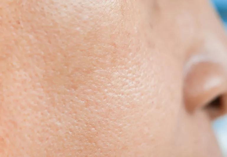 7 Dermatologist Approved Tips to Shrink Your Pores