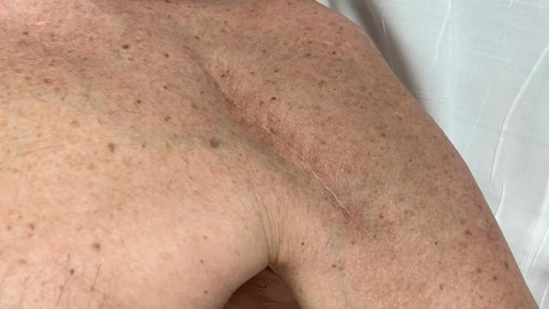 Incision after shoulder arthroplasty